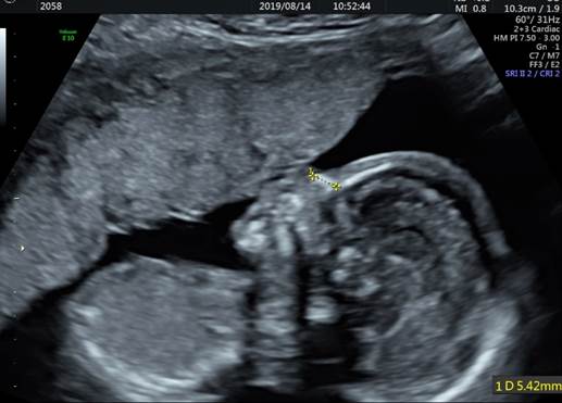 سونوگرافی جامع سه ماهه دوم بارداری